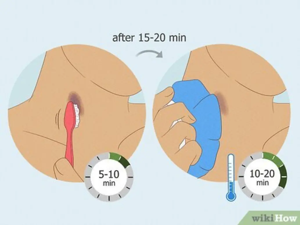 HICKIES installation process step
